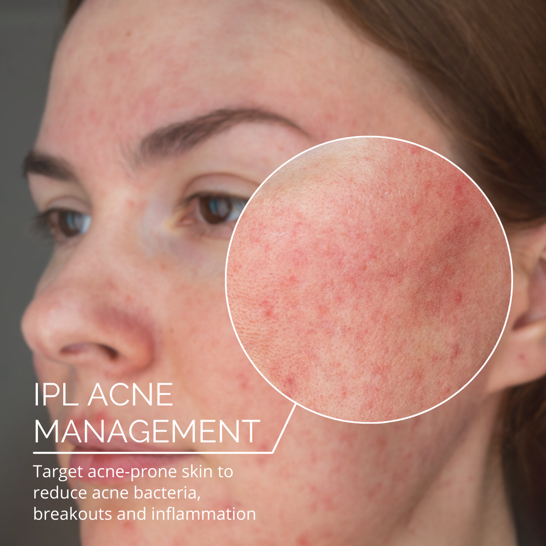 IPL Acne Treatments